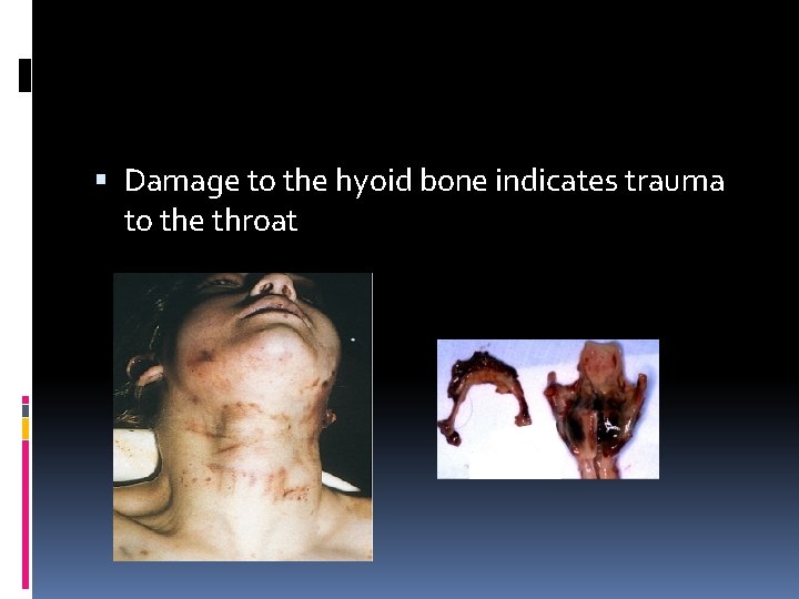  Damage to the hyoid bone indicates trauma to the throat 