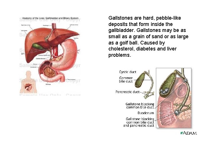 Gallstones are hard, pebble-like deposits that form inside the gallbladder. Gallstones may be as