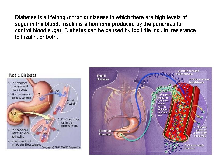 Diabetes is a lifelong (chronic) disease in which there are high levels of sugar