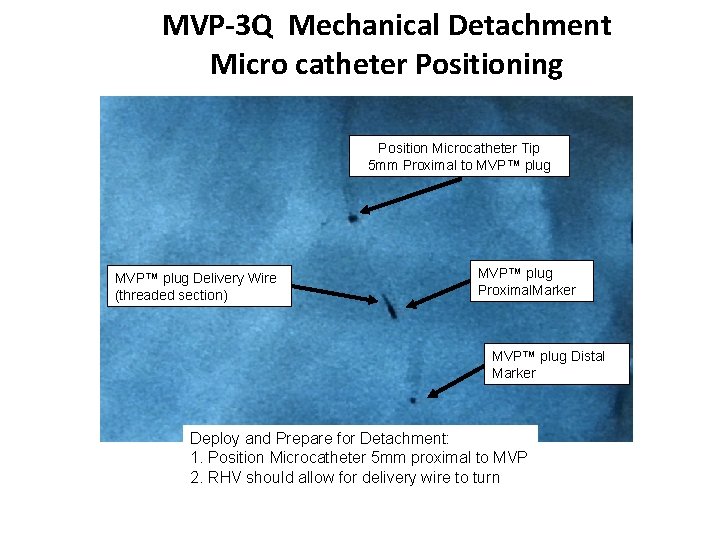 MVP-3 Q Mechanical Detachment Micro catheter Positioning Position Microcatheter Tip 5 mm Proximal to