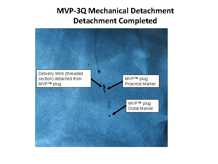 MVP-3 Q Mechanical Detachment Completed Delivery Wire (threaded section) detached from MVP™ plug Proximal