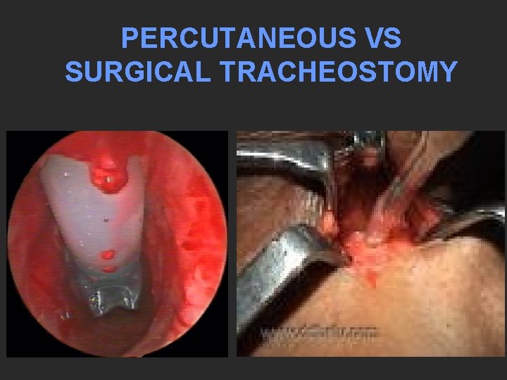 PERCUTANEOUS VS SURGICAL TRACHEOSTOMY 