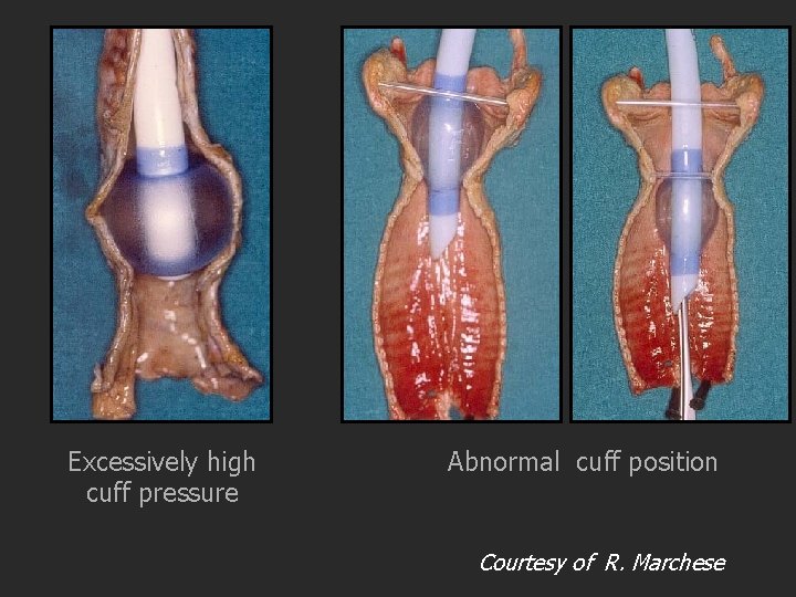 Excessively high cuff pressure Abnormal cuff position Courtesy of R. Marchese 