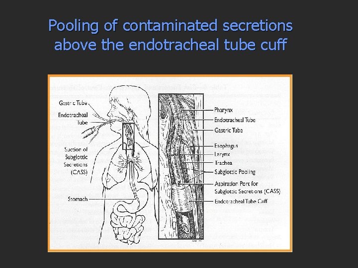 Pooling of contaminated secretions above the endotracheal tube cuff 