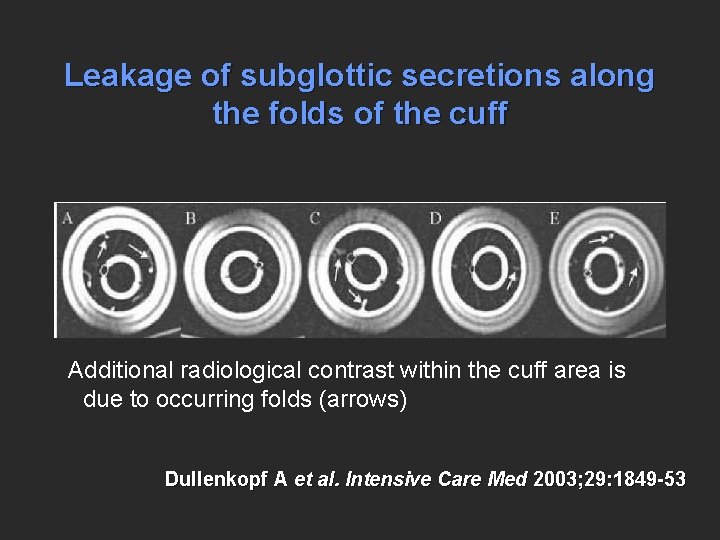 Leakage of subglottic secretions along the folds of the cuff Additional radiological contrast within