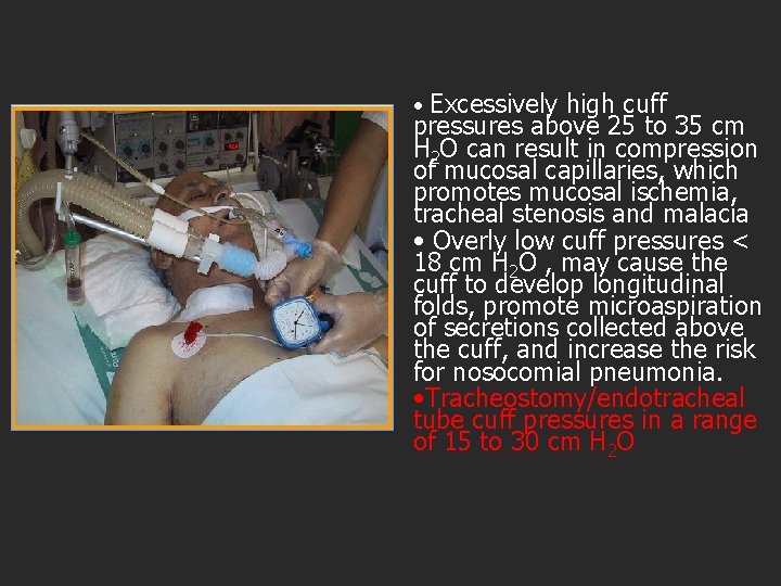  • Excessively high cuff pressures above 25 to 35 cm H 2 O
