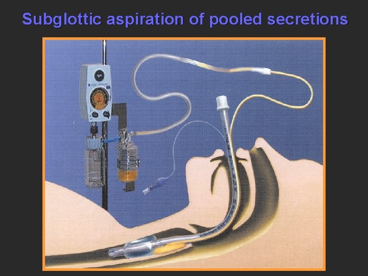 Subglottic aspiration of pooled secretions 