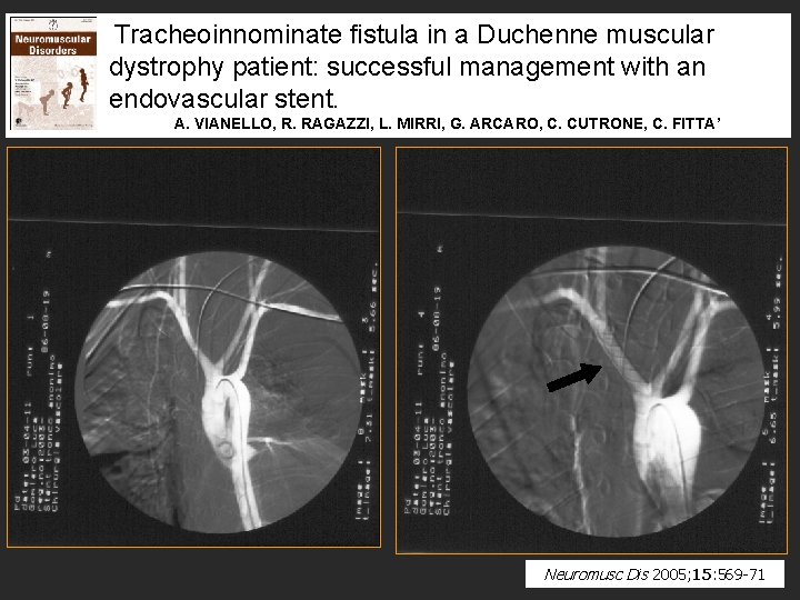 Tracheoinnominate fistula in a Duchenne muscular dystrophy patient: successful management with an endovascular stent.