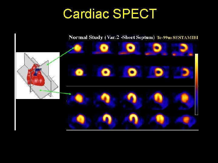 Cardiac SPECT 