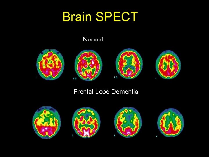 Brain SPECT Frontal Lobe Dementia 