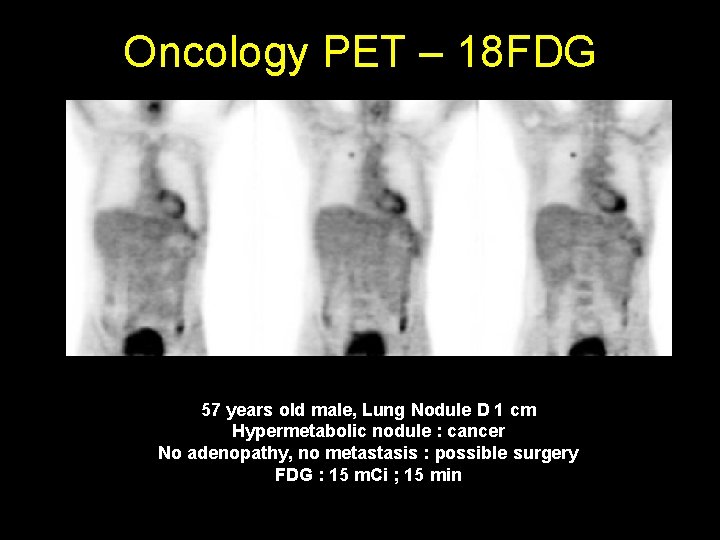 Oncology PET – 18 FDG 57 years old male, Lung Nodule D 1 cm