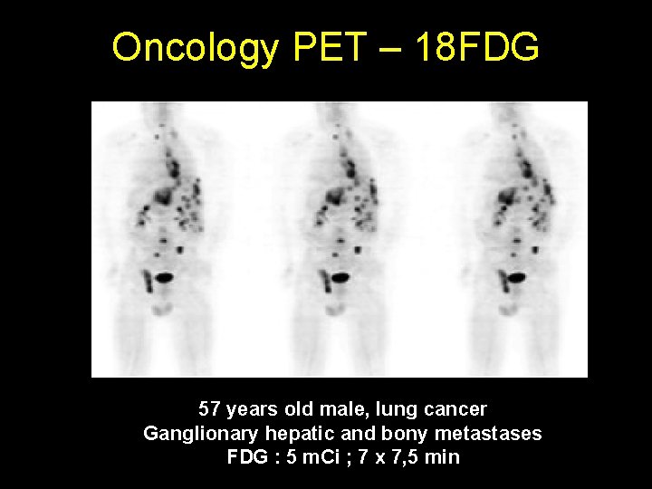 Oncology PET – 18 FDG 57 years old male, lung cancer Ganglionary hepatic and