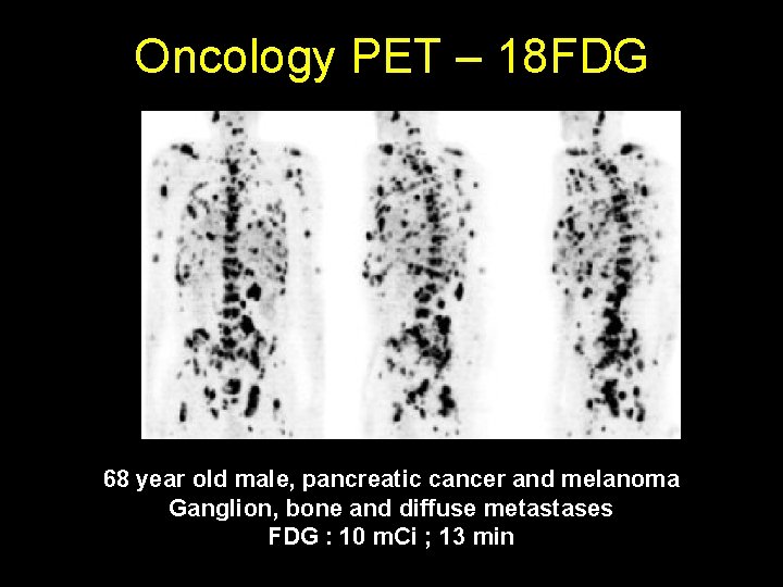 Oncology PET – 18 FDG 68 year old male, pancreatic cancer and melanoma Ganglion,