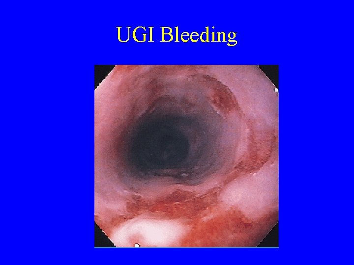 UGI Bleeding 