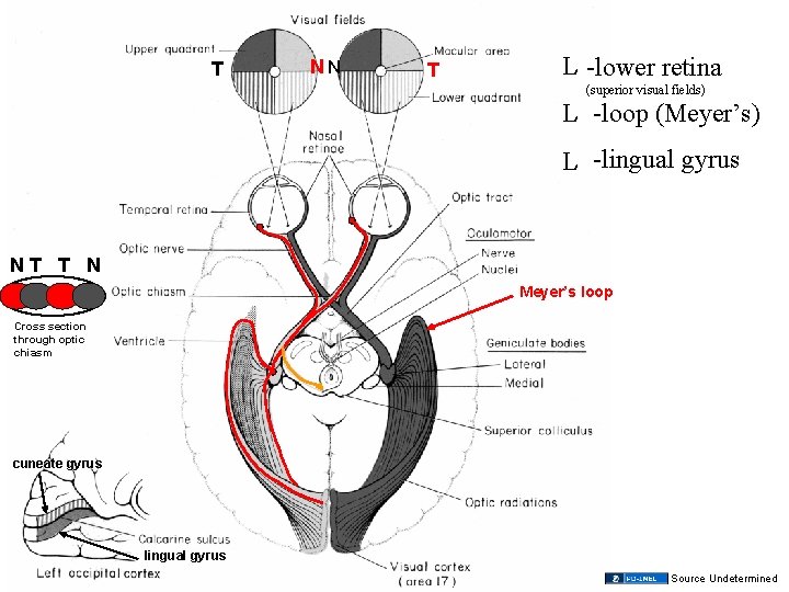 T NN T L -lower retina (superior visual fields) L -loop (Meyer’s) L -lingual