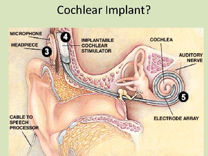 Cochlear Implant? 