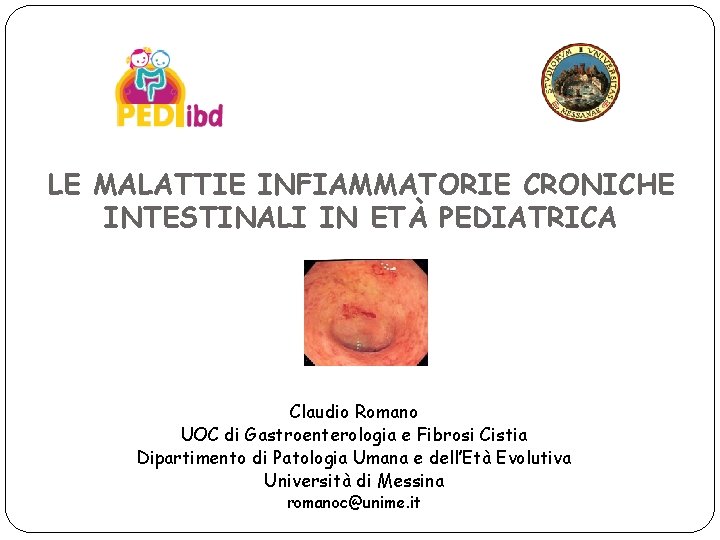 LE MALATTIE INFIAMMATORIE CRONICHE INTESTINALI IN ETÀ PEDIATRICA Claudio Romano UOC di Gastroenterologia e