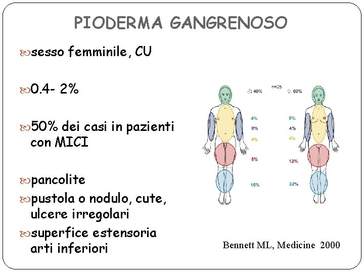 PIODERMA GANGRENOSO sesso femminile, CU 0. 4 - 2% 50% dei casi in pazienti