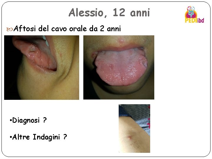 Alessio, 12 anni Aftosi del cavo orale da 2 anni • Diagnosi ? •