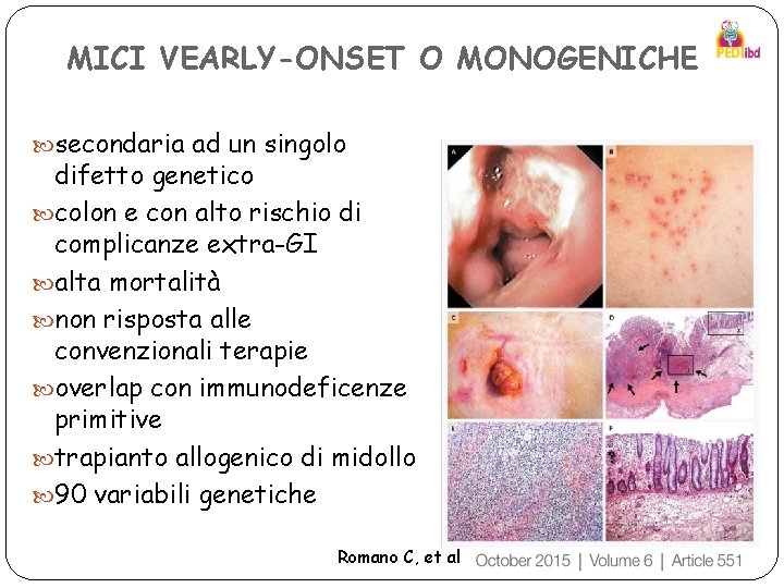 MICI VEARLY-ONSET O MONOGENICHE secondaria ad un singolo difetto genetico colon e con alto