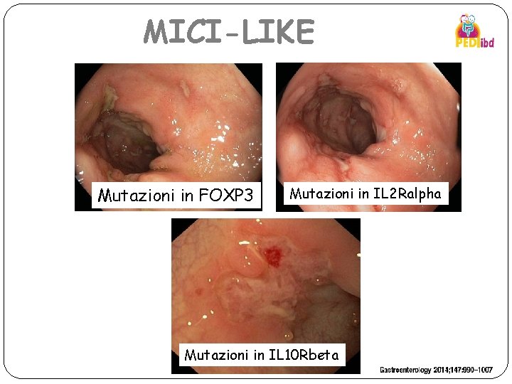 MICI-LIKE Mutazioni in FOXP 3 Mutazioni in IL 2 Ralpha Mutazioni in IL 10