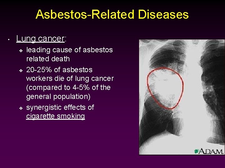 Asbestos-Related Diseases • Lung cancer: v v v leading cause of asbestos related death