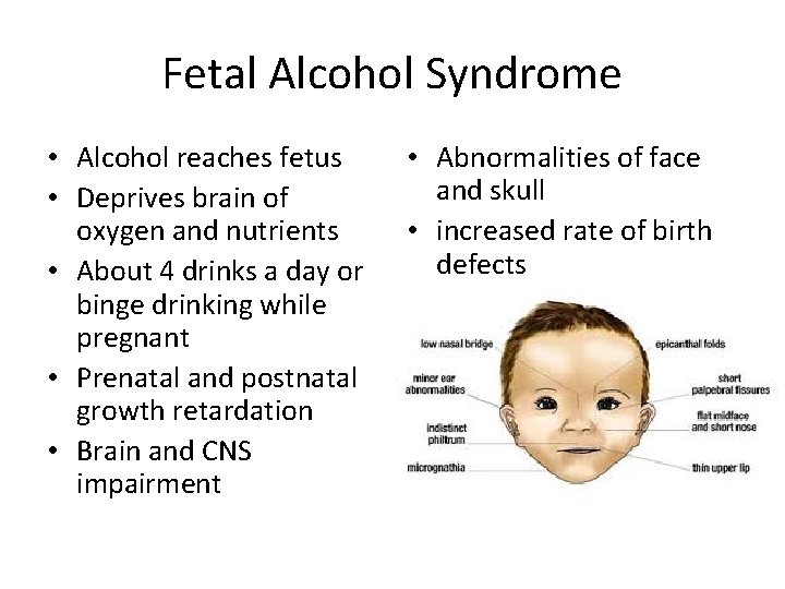 Fetal Alcohol Syndrome • Alcohol reaches fetus • Deprives brain of oxygen and nutrients