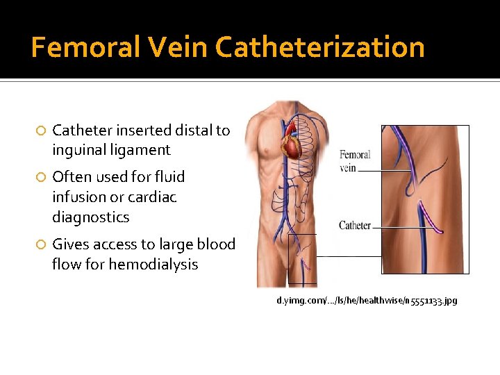 Femoral Vein Catheterization Catheter inserted distal to inguinal ligament Often used for fluid infusion