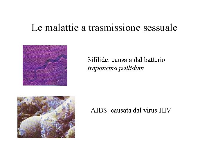 Le malattie a trasmissione sessuale Sifilide: causata dal batterio treponema pallidum AIDS: causata dal
