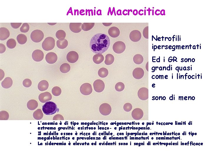Anemia Macrocitica Netrofili ipersegmentati Ed i GR sono grandi quasi come i linfociti e