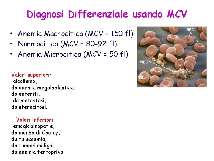 Diagnosi Differenziale usando MCV • Anemia Macrocitica (MCV = 150 fl) • Normocitica (MCV