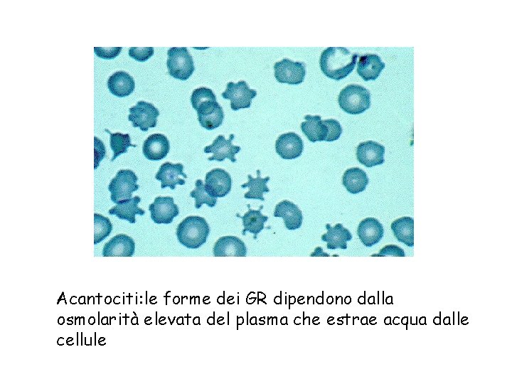 Acantociti: le forme dei GR dipendono dalla osmolarità elevata del plasma che estrae acqua