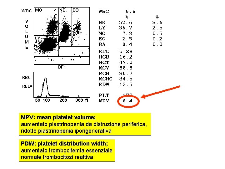 MPV: mean platelet volume; aumentato piastrinopenia da distruzione periferica, ridotto piastrinopenia iporigenerativa PDW: platelet