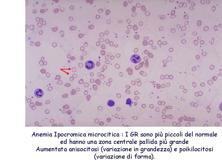 Anemia Ipocromica microcitica : I GR sono più piccoli del normale ed hanno una