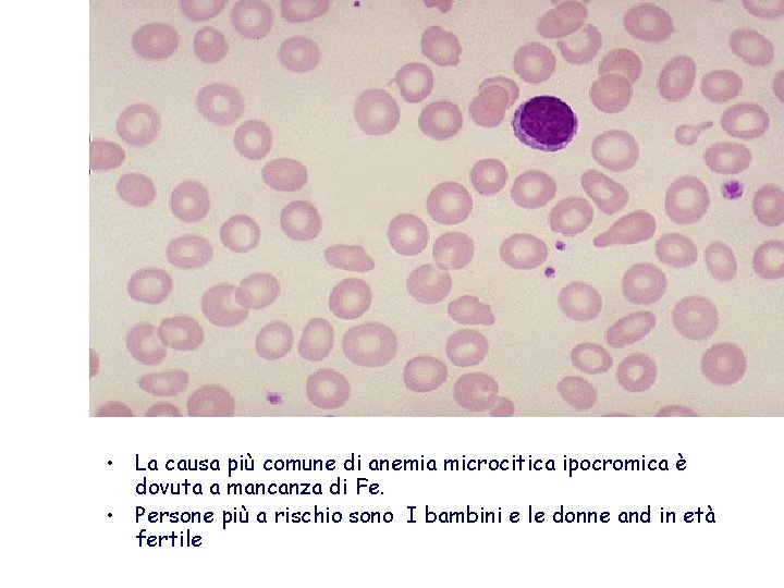  • La causa più comune di anemia microcitica ipocromica è dovuta a mancanza