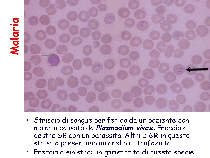 Malaria • Striscio di sangue periferico da un paziente con malaria causata da Plasmodium