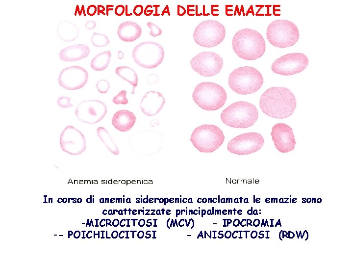 MORFOLOGIA DELLE EMAZIE In corso di anemia sideropenica conclamata le emazie sono caratterizzate principalmente