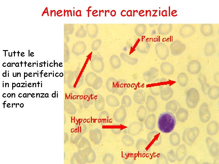 Anemia ferro carenziale Tutte le caratteristiche di un periferico in pazienti con carenza di