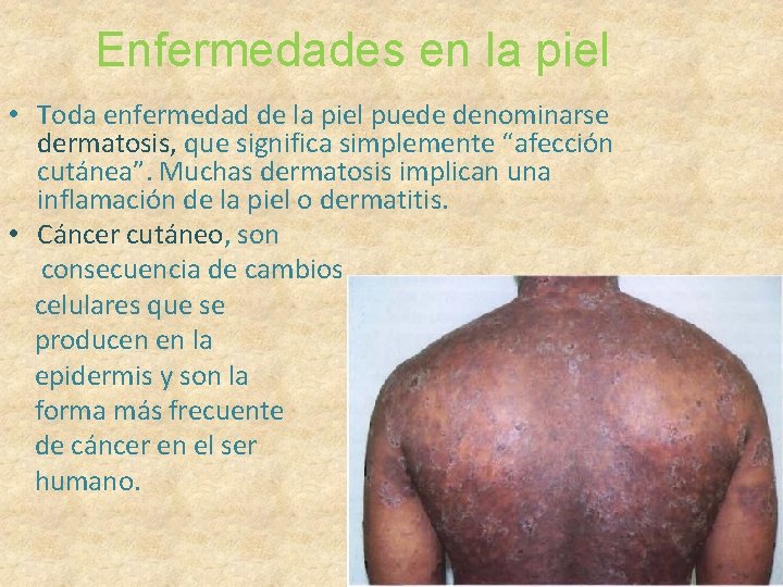 Enfermedades en la piel • Toda enfermedad de la piel puede denominarse dermatosis, que