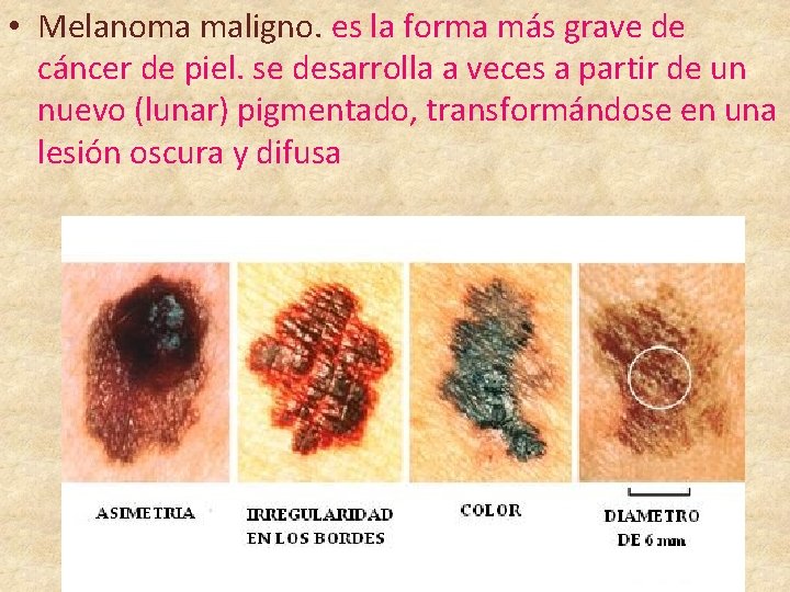  • Melanoma maligno. es la forma más grave de cáncer de piel. se