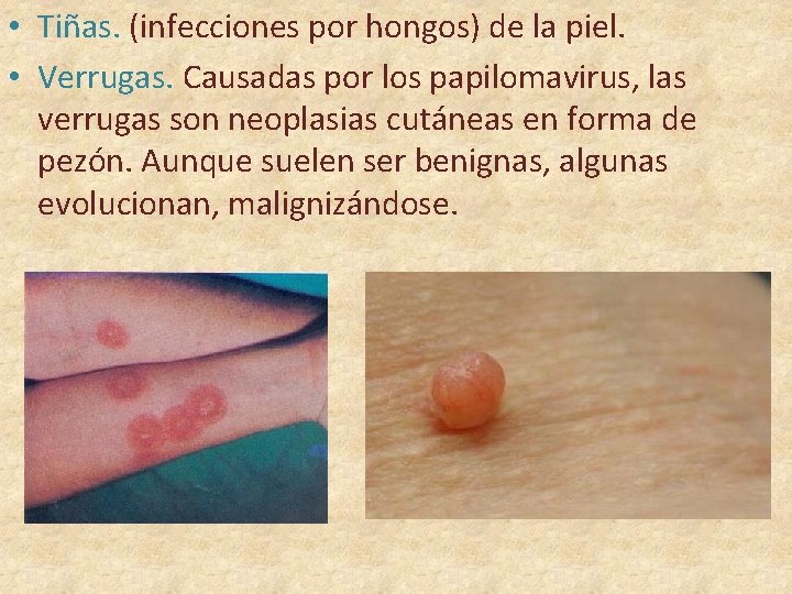  • Tiñas. (infecciones por hongos) de la piel. • Verrugas. Causadas por los