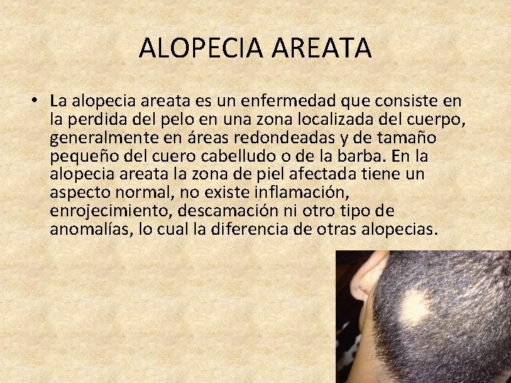 ALOPECIA AREATA • La alopecia areata es un enfermedad que consiste en la perdida