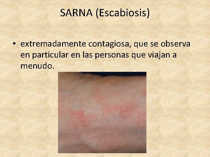 SARNA (Escabiosis) • extremadamente contagiosa, que se observa en particular en las personas que
