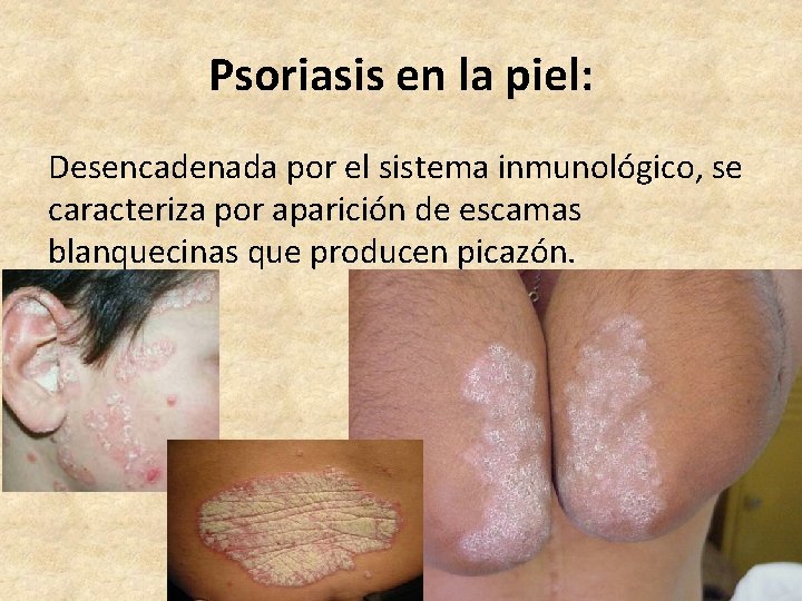 Psoriasis en la piel: Desencadenada por el sistema inmunológico, se caracteriza por aparición de