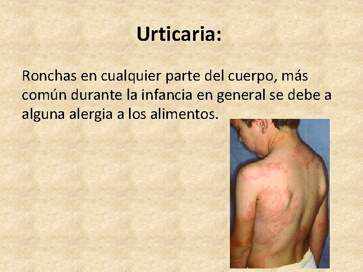 Urticaria: Ronchas en cualquier parte del cuerpo, más común durante la infancia en general