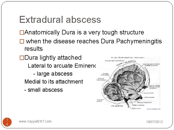 Extradural abscess �Anatomically Dura is a very tough structure � when the disease reaches