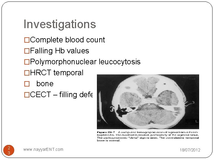 Investigations �Complete blood count �Falling Hb values �Polymorphonuclear leucocytosis �HRCT temporal � bone �CECT