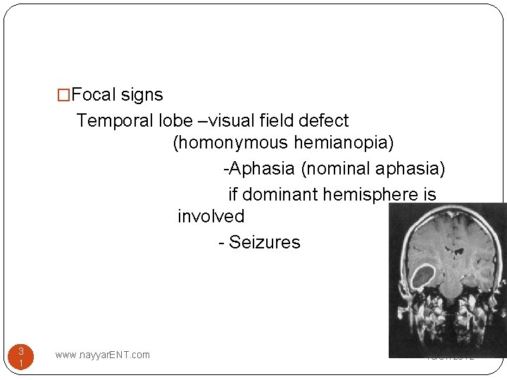 �Focal signs Temporal lobe –visual field defect (homonymous hemianopia) -Aphasia (nominal aphasia) if dominant