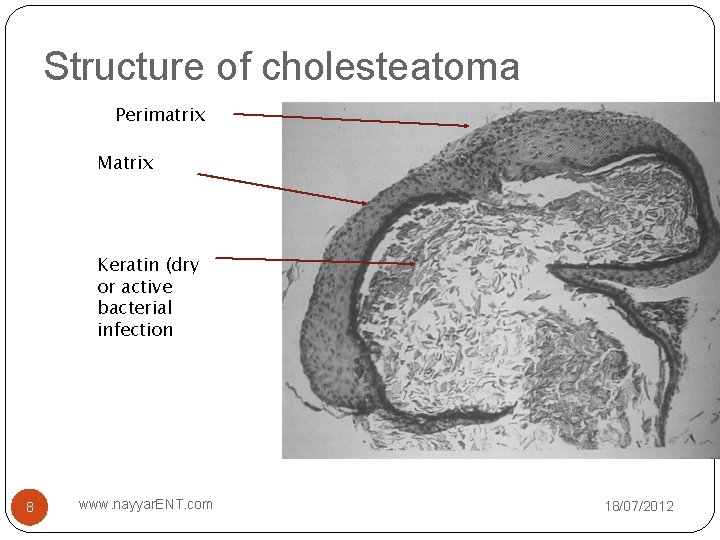 Structure of cholesteatoma Perimatrix Matrix Keratin (dry or active bacterial infection 8 www. nayyar.