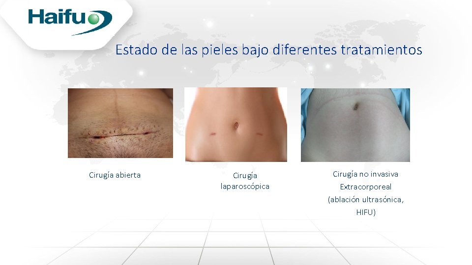 Estado de las pieles bajo diferentes tratamientos Cirugía abierta Cirugía laparoscópica Cirugía no invasiva